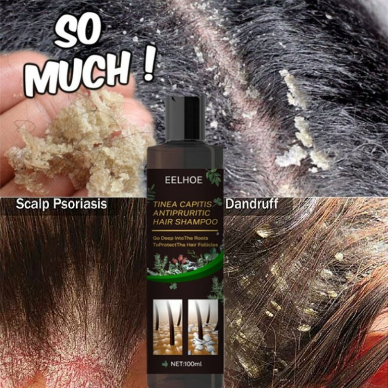 Itching and Flaking Scalp Psoriasis and Seborrheic Dermatitis Hair